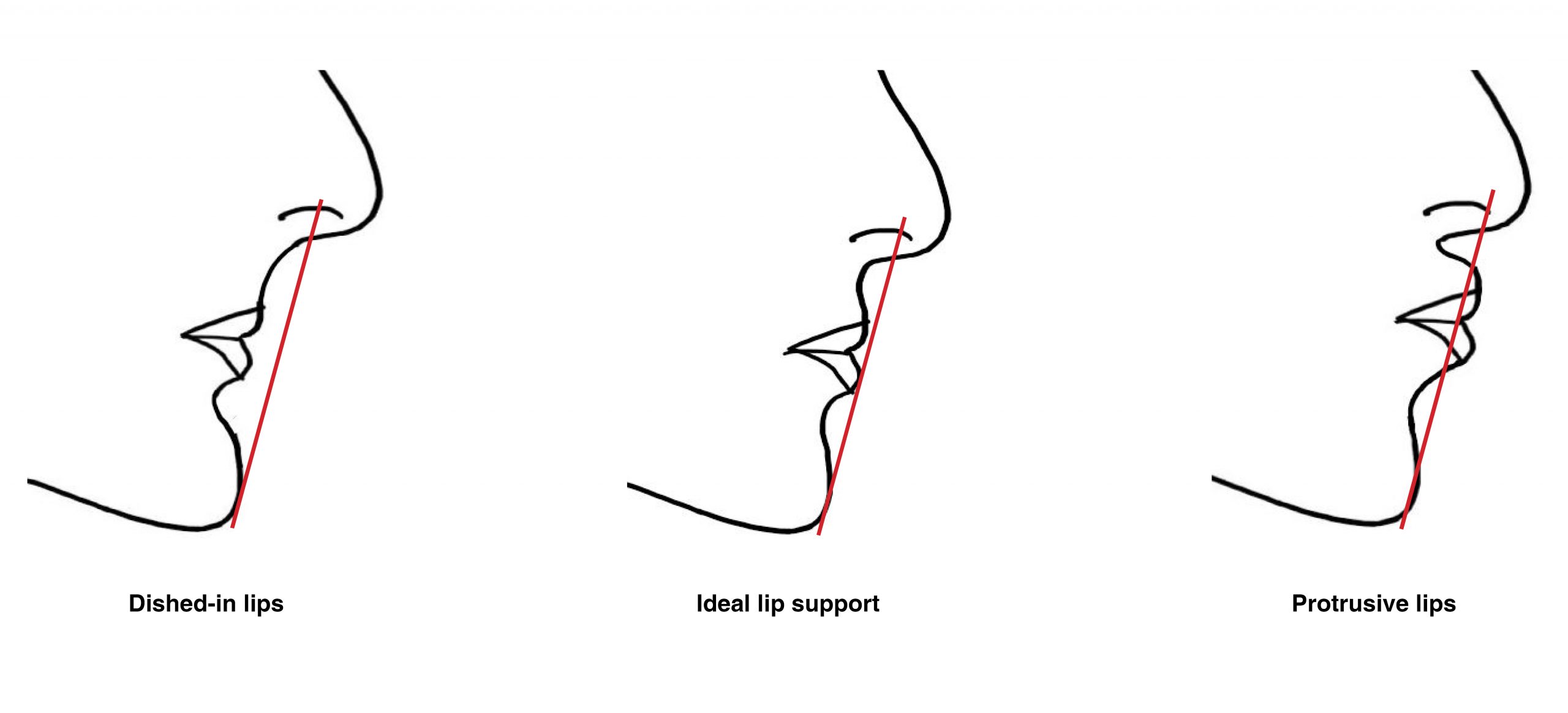 Lip support