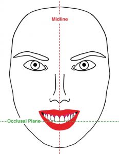 Normal Face Midline w smile and lines FR